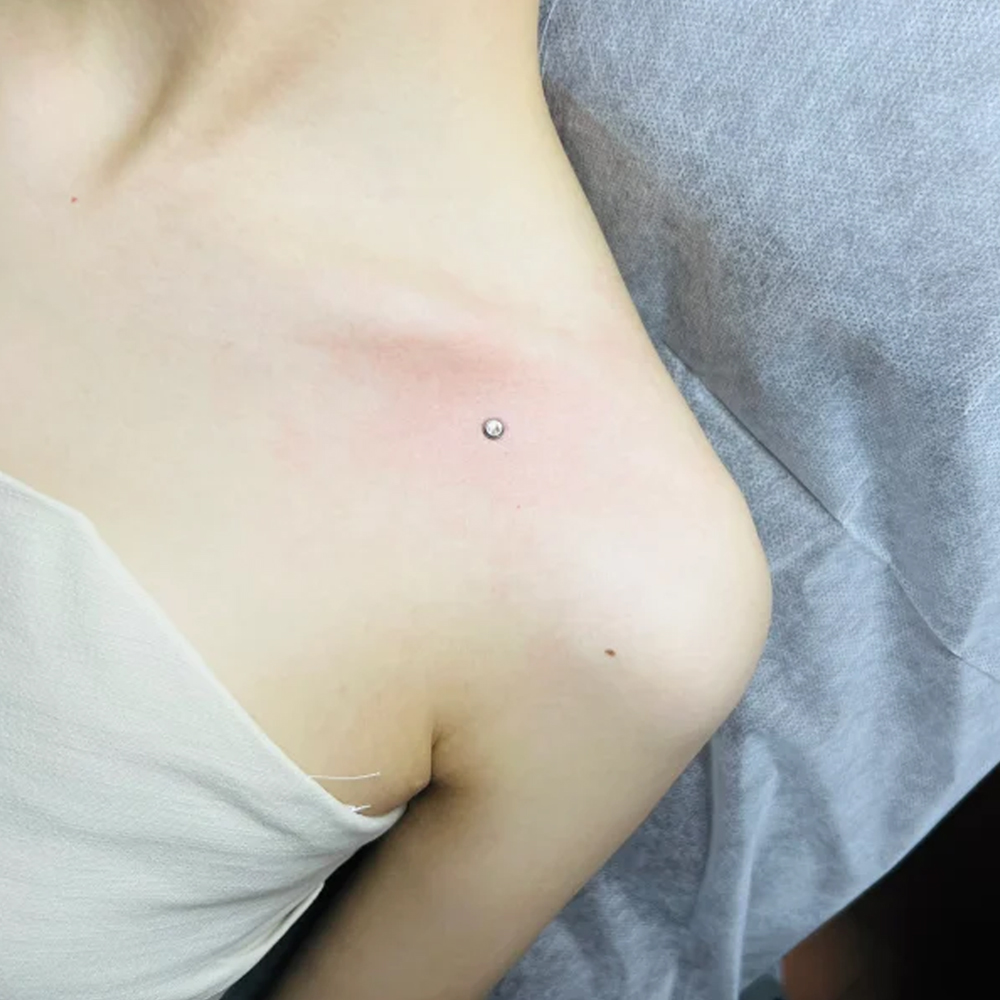 Хирургический стальной поверхн – обзор и цена Dermal Anchor Top
